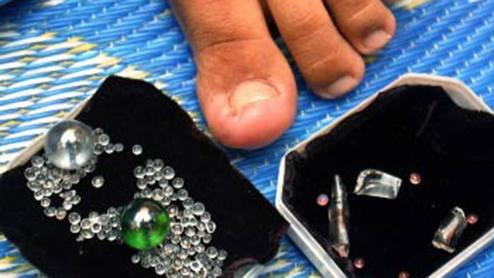 Cô gái có ngón chân ‘nhả ngọc’, bộ sưu tập ‘đá quý’ được mua lại để nghiên cứu - 1