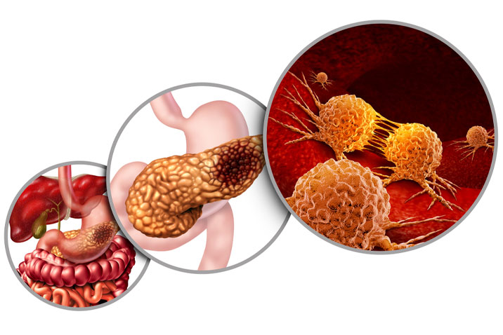 Những dấu hiệu cảnh báo ung thư tuyến tụy: Có cảm giác khác lạ ở dưới xương sườn - 1