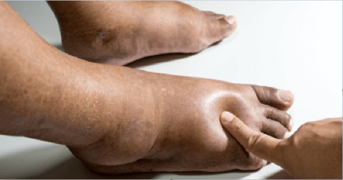 10 dấu hiệu sớm cảnh báo bệnh thận: Đi khám ngay khi thấy triệu chứng đầu tiên - 2