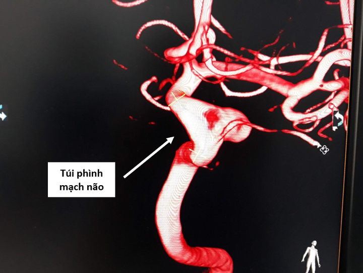 Cảnh giác nguy cơ bệnh lý nặng khi bị đau đầu kéo dài - 2