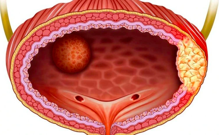 4 dấu hiệu cảnh báo ung thư bàng quang: Phát hiện sớm có thể kéo dài sự sống - 2