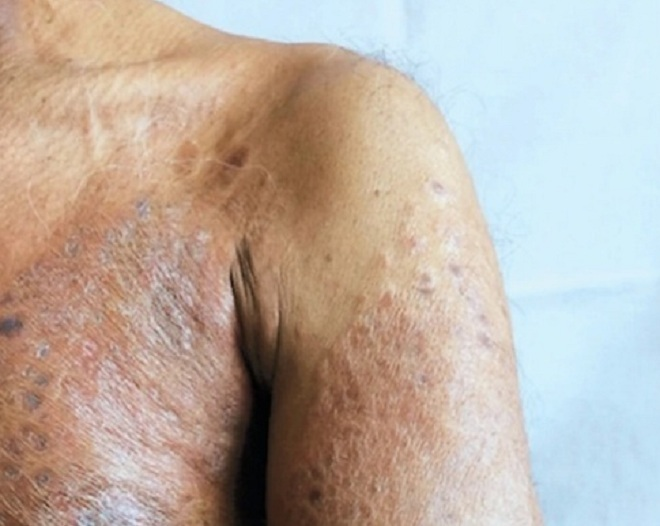 Sự thay đổi ở da cảnh báo ung thư vú: Nhầm lẫn với bệnh da liễu sẽ nguy hiểm - 1