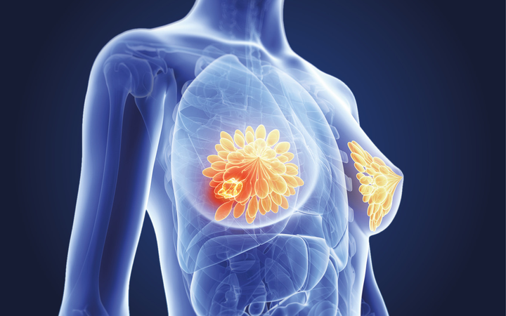 Sự thay đổi ở da cảnh báo ung thư vú: Nhầm lẫn với bệnh da liễu sẽ nguy hiểm - 2