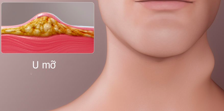 3 yếu tố gây ra bệnh u mỡ: Cách phát hiện để xử lý sớm, ngăn ngừa tiến triển - 1