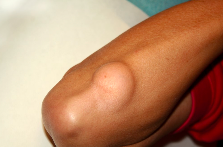 3 yếu tố gây ra bệnh u mỡ: Cách phát hiện để xử lý sớm, ngăn ngừa tiến triển - 2