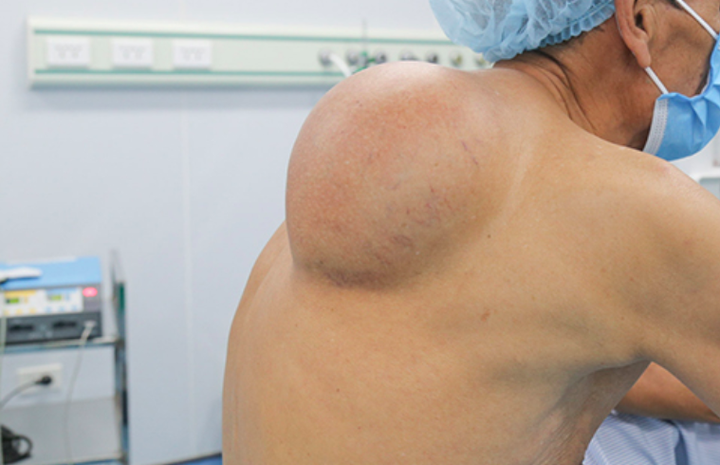 3 yếu tố gây ra bệnh u mỡ: Cách phát hiện để xử lý sớm, ngăn ngừa tiến triển - 3