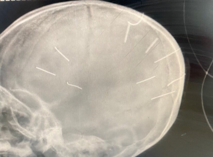 Hà Nội: Bé 3 tuổi hôn mê, X-quang có đinh trong sọ, nghi bị bạo hành - 1