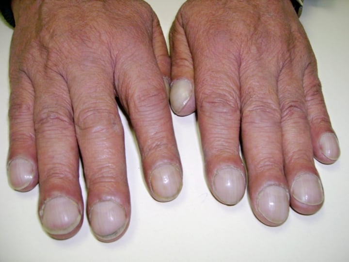 6 vấn đề sức khỏe biểu hiện qua móng tay: Quan sát hàng ngày giúp phát hiện bệnh - 3