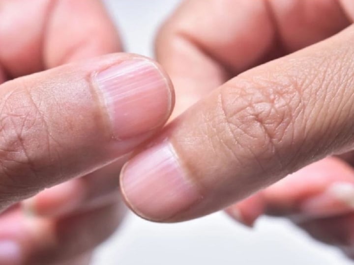 6 vấn đề sức khỏe biểu hiện qua móng tay: Quan sát hàng ngày giúp phát hiện bệnh - 2