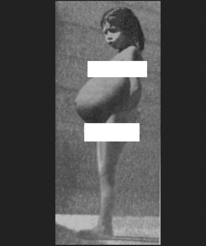 Hy hữu cô bé sinh con khi mới 5 tuổi và câu hỏi không lời đáp suốt nhiều năm qua - 1