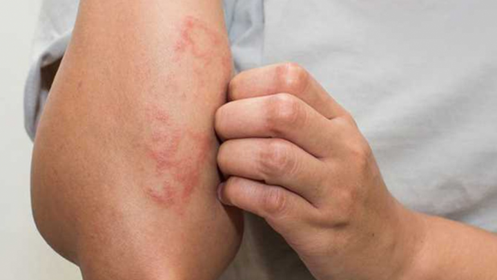 Dấu hiệu trên da cảnh báo bệnh thận đang phát triển: Cẩn thận với nhiễm độc niệu - 1