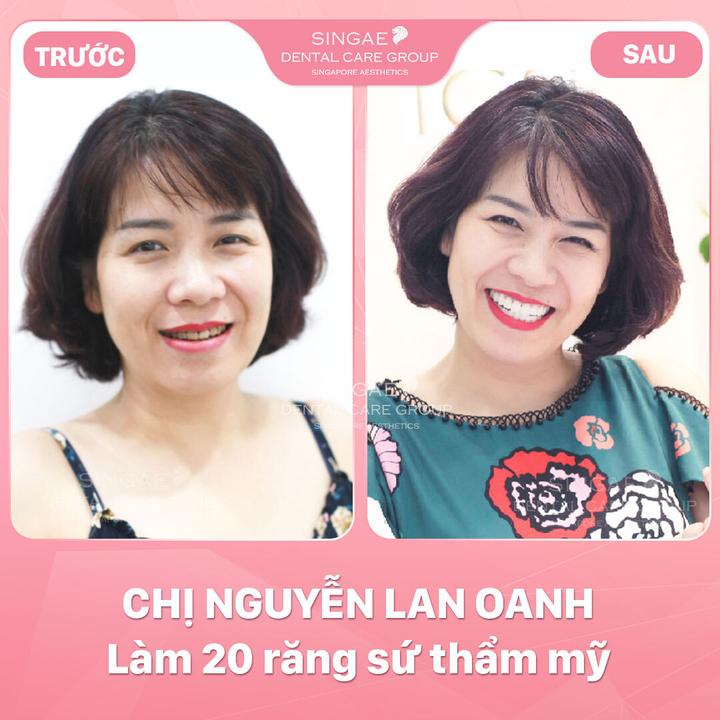 Nha khoa Singae bật mí 3 yếu tố tạo nên nụ cười toả nắng - 1