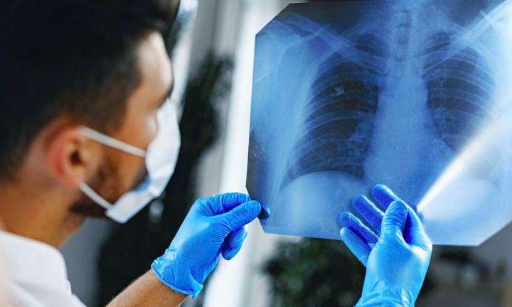 4 kiểu ho cảnh báo bệnh ung thư phổi: Đừng nhầm lẫn với các cơn ho thông thường - 3