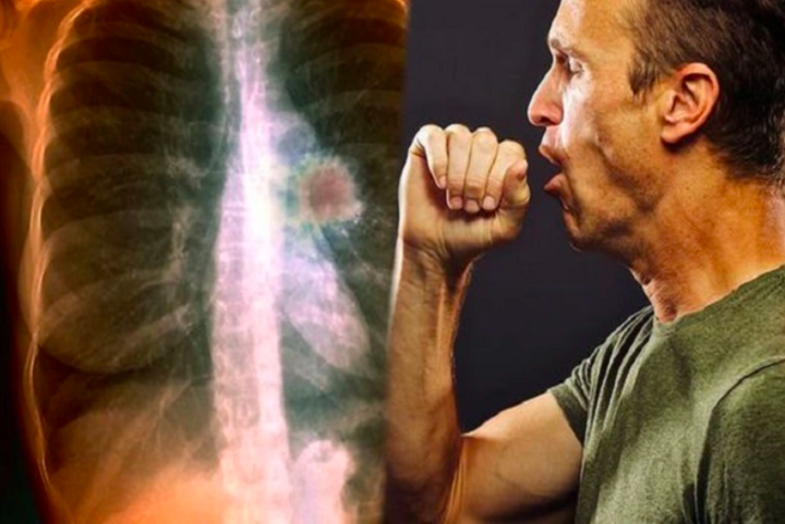 4 kiểu ho cảnh báo bệnh ung thư phổi: Đừng nhầm lẫn với các cơn ho thông thường - 2