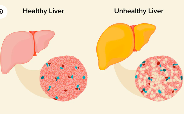 6 việc giúp loại bỏ sớm bệnh gan nhiễm mỡ: Sau Tết là thời điểm tốt nhất để làm - 2