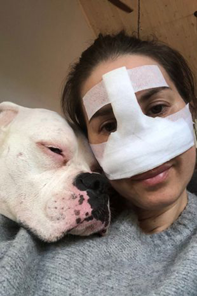 Cứ rửa mặt là đau, cô gái phải cắt toàn bộ mũi - 2