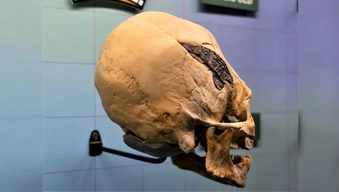 Bí ẩn hộp sọ người gắn kim loại có niên đại hàng ngàn năm - 2