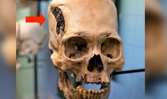 Bí ẩn hộp sọ người gắn kim loại có niên đại hàng ngàn năm - 1