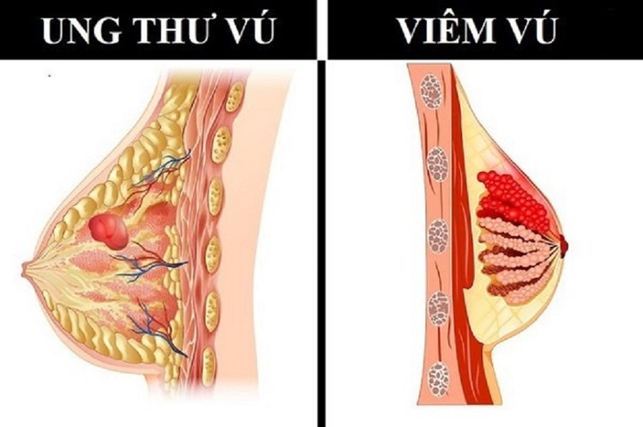 7 loại viêm nhiễm không nên coi thường vì dễ dẫn đến ung thư - 6
