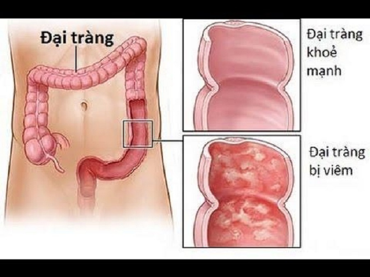 7 loại viêm nhiễm không nên coi thường vì dễ dẫn đến ung thư - 1