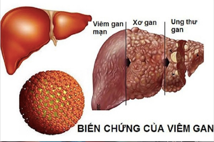 7 loại viêm nhiễm không nên coi thường vì dễ dẫn đến ung thư - 2