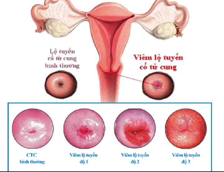 7 loại viêm nhiễm không nên coi thường vì dễ dẫn đến ung thư - 4