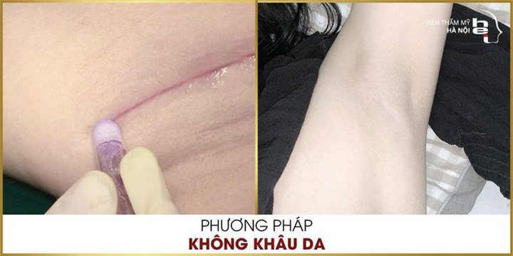Người tiên phong phương pháp phẫu thuật không khâu da tại Việt Nam - 2