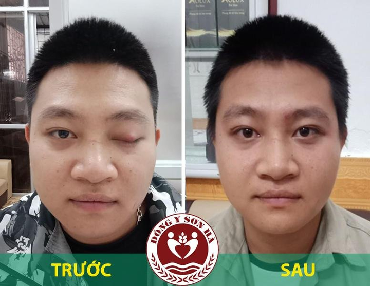 Địa chỉ chữa sụp mí mắt bằng Đông y hiệu quả - 1