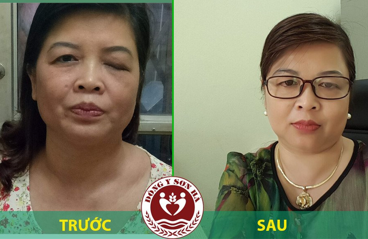 Địa chỉ chữa sụp mí mắt bằng Đông y hiệu quả - 2