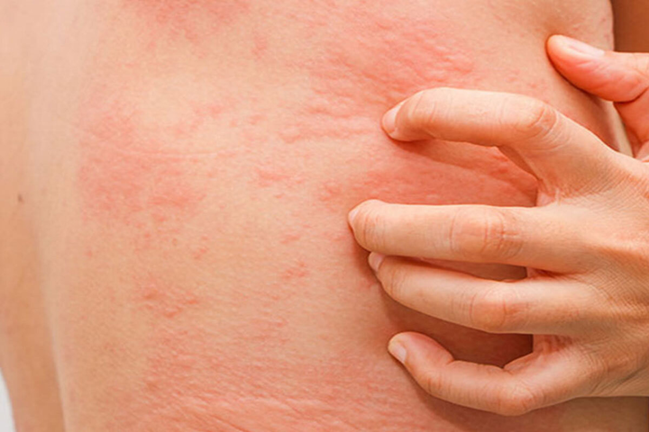 Bệnh nhân COVID-19 nổi mày đay: Nguyên nhân và cách điều trị - 1