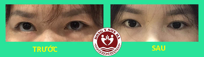 Phương pháp chữa lác mắt hiệu quả bằng Đông y - 1