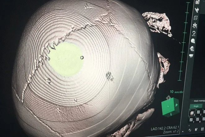 Toàn cảnh vụ bé gái 3 tuổi chết do bị người tình của mẹ găm đinh vào đầu - 2