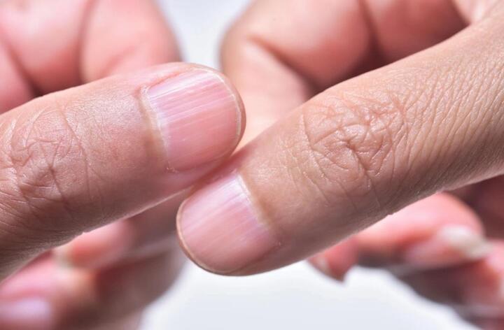 Các dấu hiệu sớm cảnh báo bệnh suy giáp, bắt đầu từ sự thay đổi lạ trên móng tay - 1