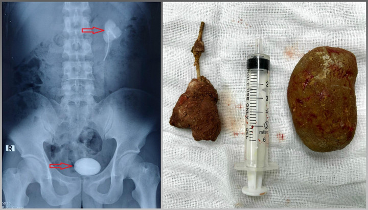 Viên sỏi to hơn quả trứng gà trong bàng quang của nam thanh niên 27 tuổi - 1