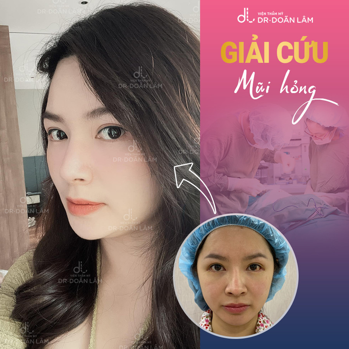 Dr Doãn Lâm: Chuyên gia 'giải cứu' thành công những ca nâng mũi hỏng - 4