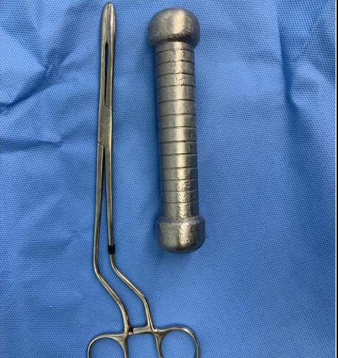 Quả tạ 2 kg mắc kẹt trong trực tràng người đàn ông khiến bác sĩ choáng váng - 2