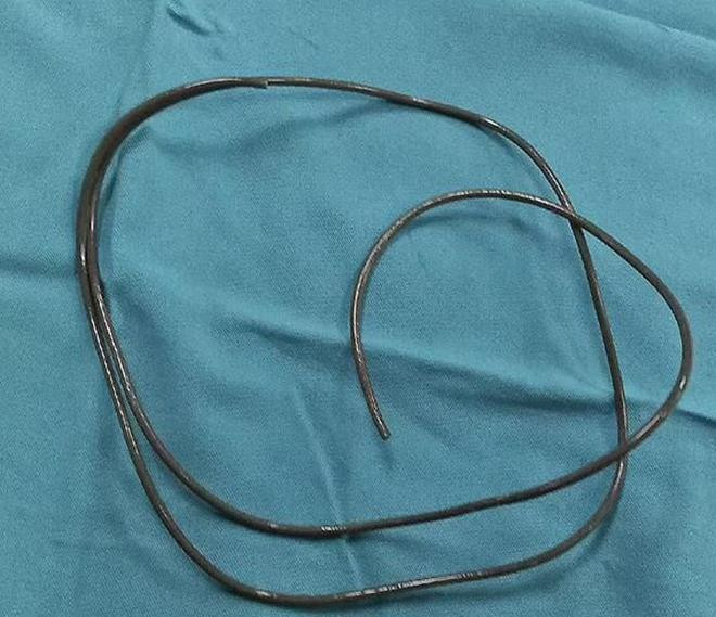 Người đàn ông phải cấp cứu sau khi nhét dây tai nghe vào niệu đạo - 2