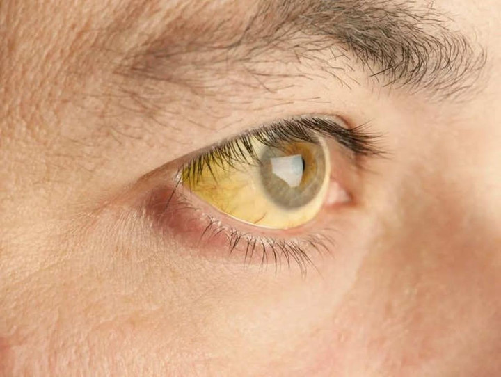 Ngứa da, thiếu tập trung - dấu hiệu cảnh báo gan có vấn đề - 1