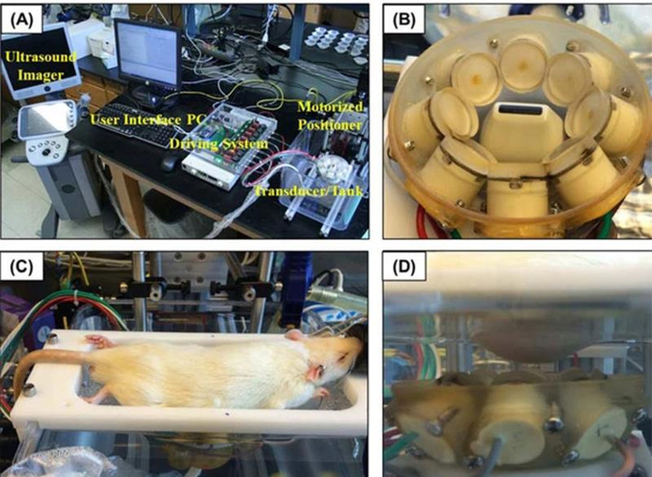 Kỹ thuật siêu âm giúp đánh tan khối u ung thư gan mà không cần phẫu thuật - 3