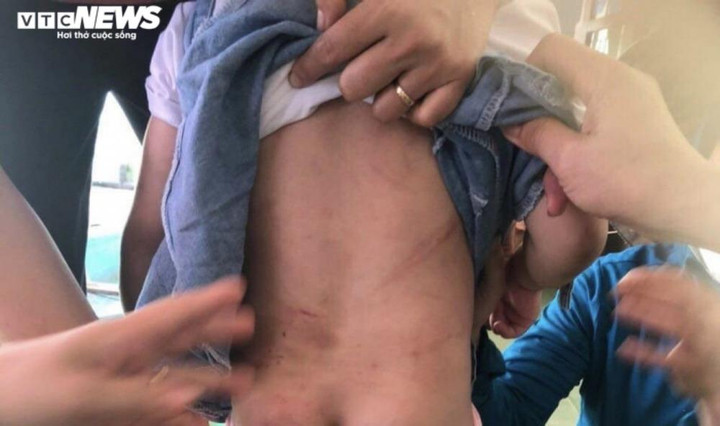 Tạm giữ dì ruột dùng chổi sắt đánh cháu gái 4 tuổi nhập viện - 1