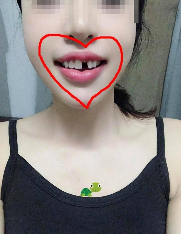 Cô gái gãy mất răng vì chân gà, đọc đến bình luận của dân mạng còn hết hồn hơn - 1