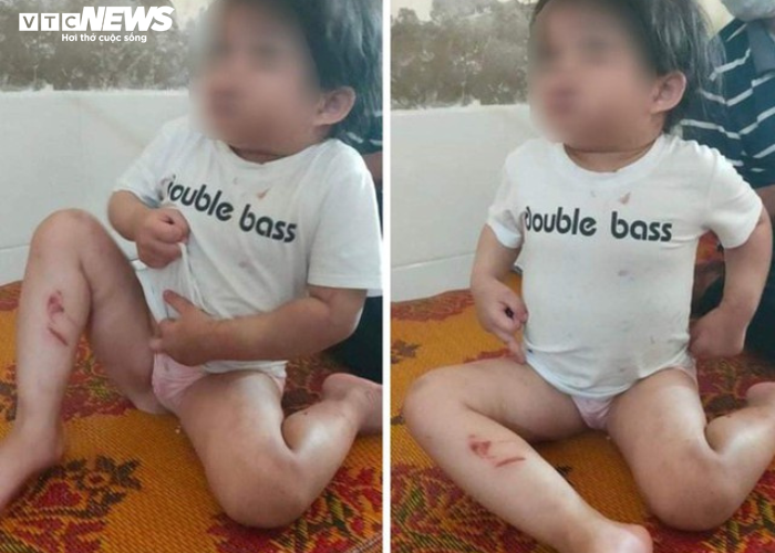 Khởi tố dì ruột dùng cán chổi đánh cháu gái 4 tuổi nhập viện - 2