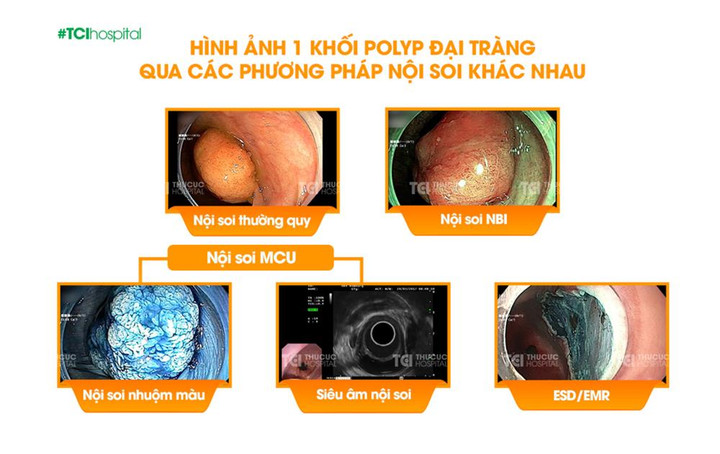 Ung thư đường tiêu hóa: Trì hoãn kiểm tra, hậu quả khó lường - 2