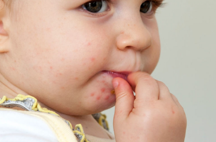 Bệnh tay chân miệng: Nguyên nhân, triệu chứng và biện pháp phòng ngừa - 1