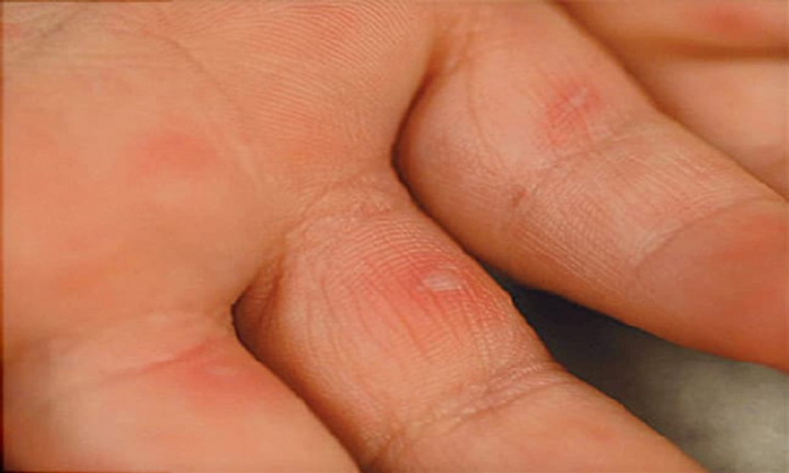 Bệnh tay chân miệng: Nguyên nhân, triệu chứng và biện pháp phòng ngừa - 2