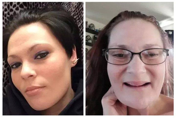 Người phụ nữ 36 tuổi già như 70 tuổi sau biến chứng viêm tủy răng - 1