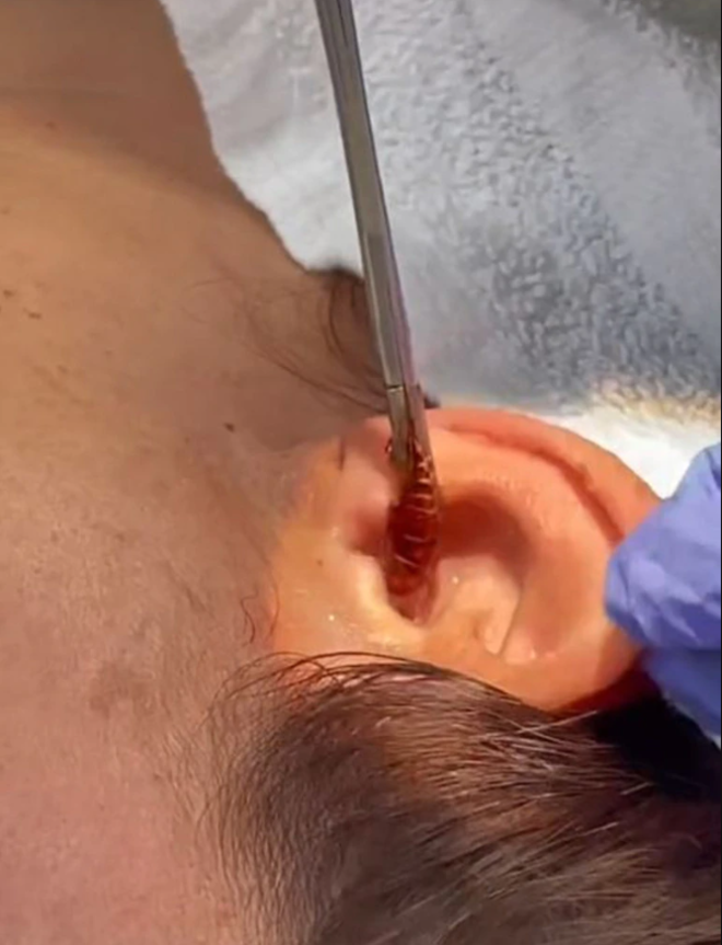 Đang ngủ bỗng thấy đau tai, cô gái kinh hãi khi thấy ‘vật lạ’ lòi ra - 2