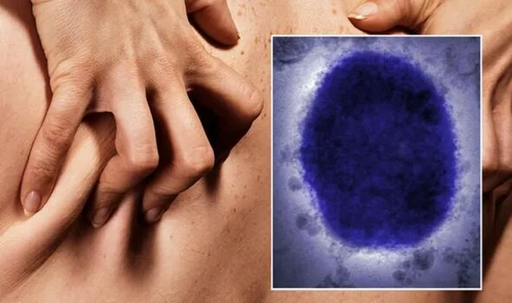Bệnh đậu mùa khỉ bùng phát: Các triệu chứng cần lưu ý - 1