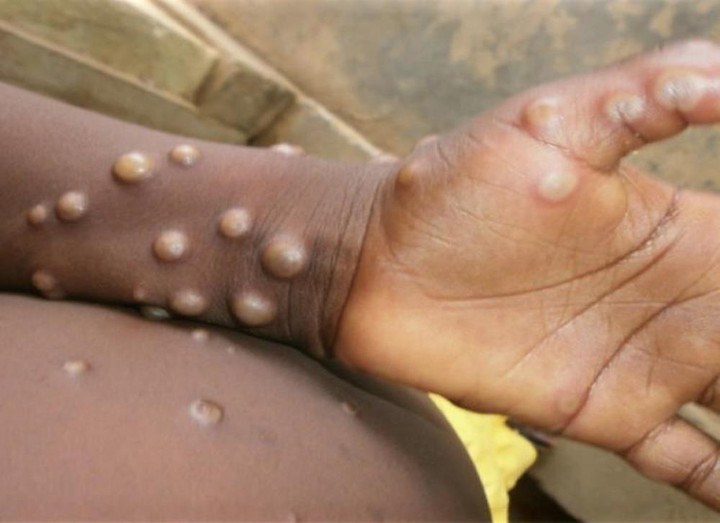 Dự báo ca bệnh đậu mùa khỉ tăng, Bộ Y tế đề nghị giám sát chặt cửa khẩu - 1