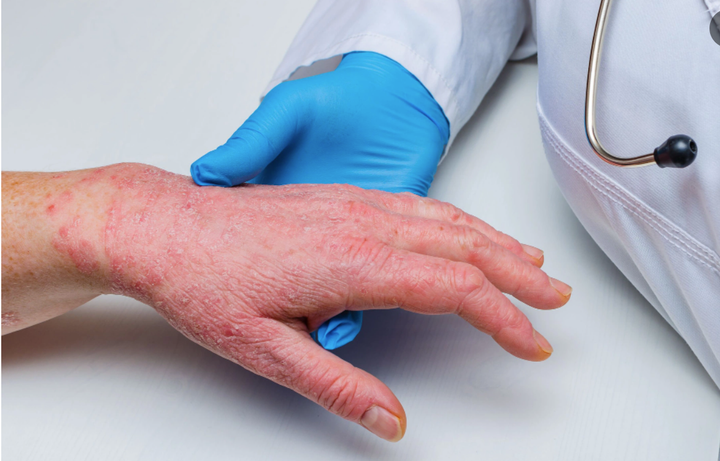 Đậu mùa khỉ lan ra 19 nước, Bộ Y tế hướng dẫn phòng bệnh - 1